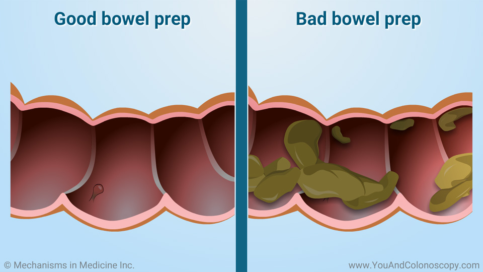 What is a colonoscopy and how do I prepare for it?