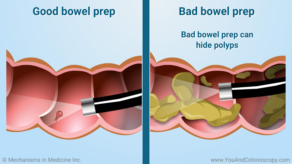 What is a colonoscopy and how do I prepare for it?