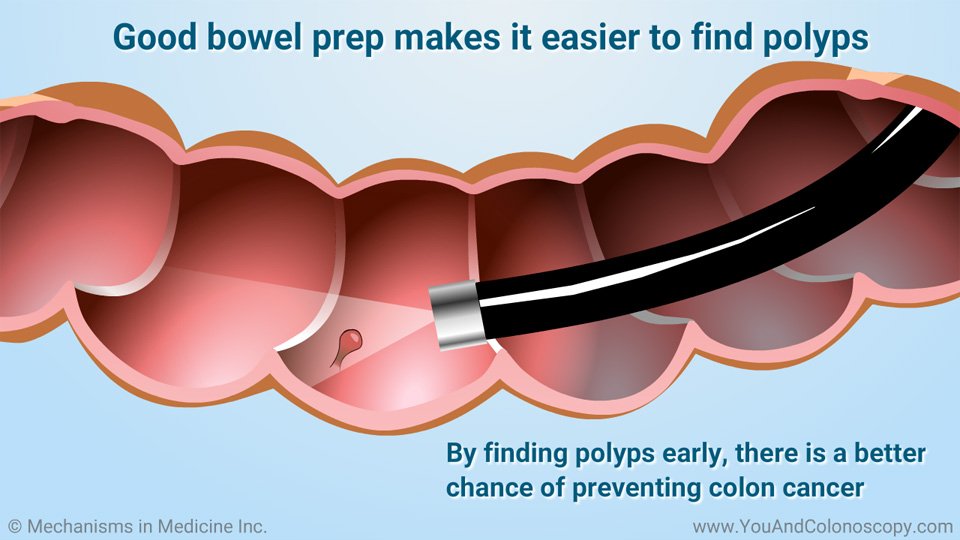 What is a colonoscopy and how do I prepare for it?