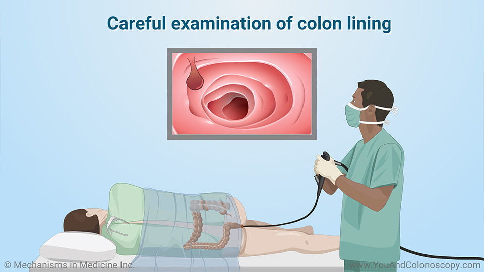 What happens during and after a colonoscopy?