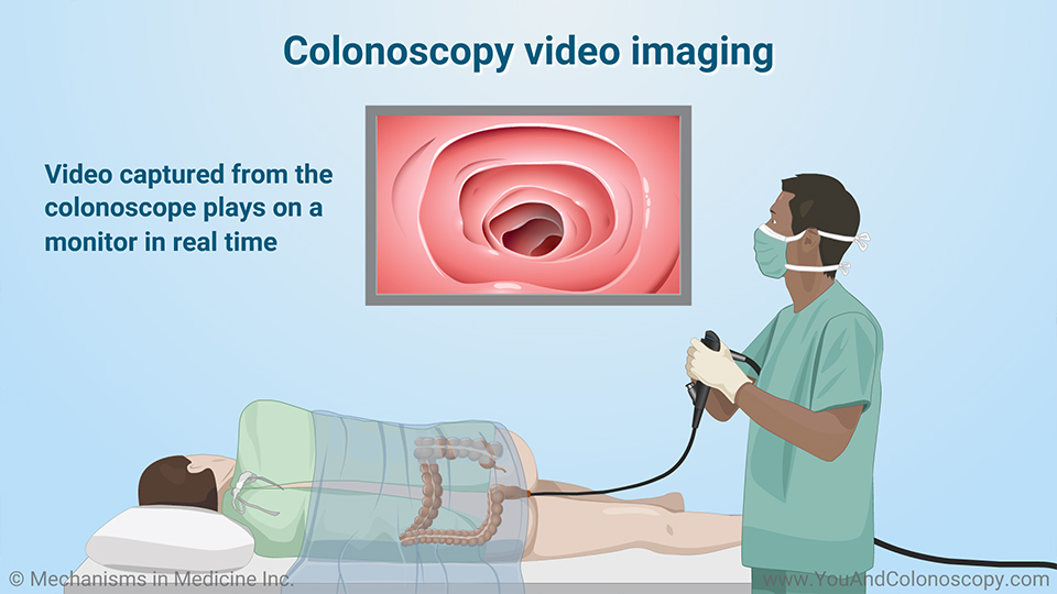 To Expect After A Colonoscopy, what happens after colonoscopy pic, download...