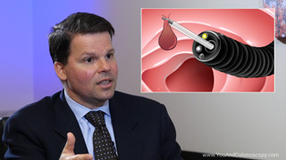 What is a polypectomy?