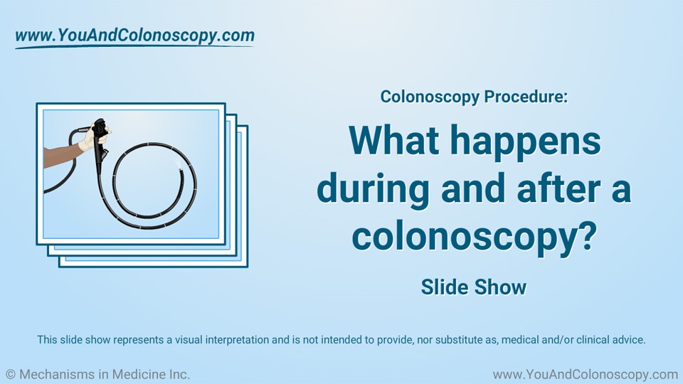 Slide Show - What happens during and after a colonoscopy?