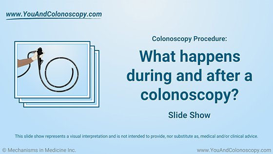 Slide Show - What happens during and after a colonoscopy?