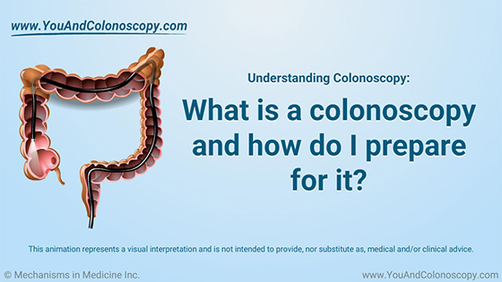 Animation - What is a colonoscopy and how do I prepare?