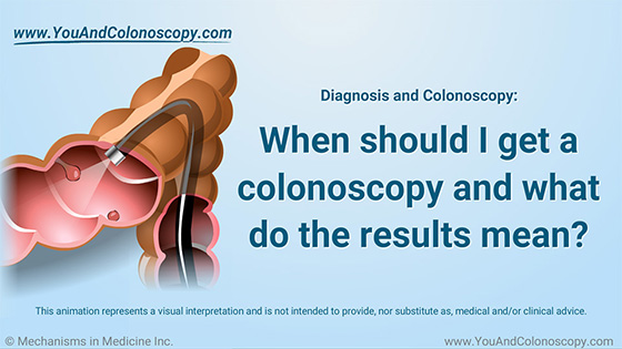 Animation - When should I get a colonoscopy?
