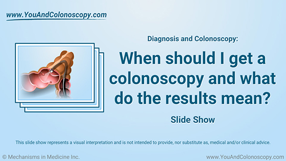 Slide Show - When should I get a colonoscopy?